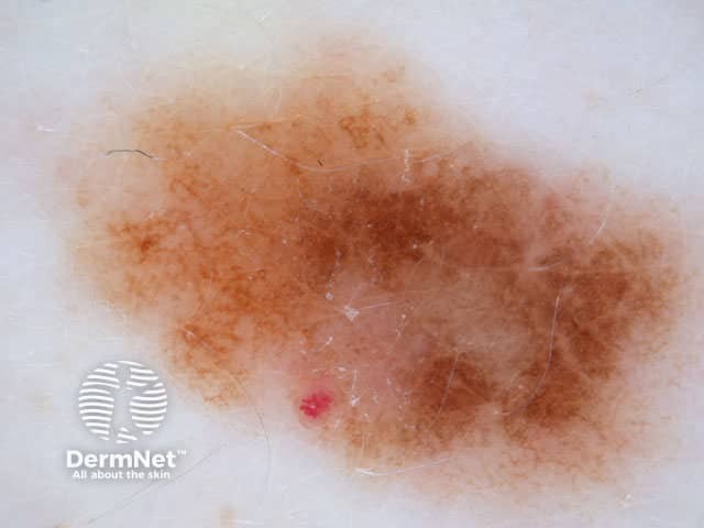 Reticular/homogeneous