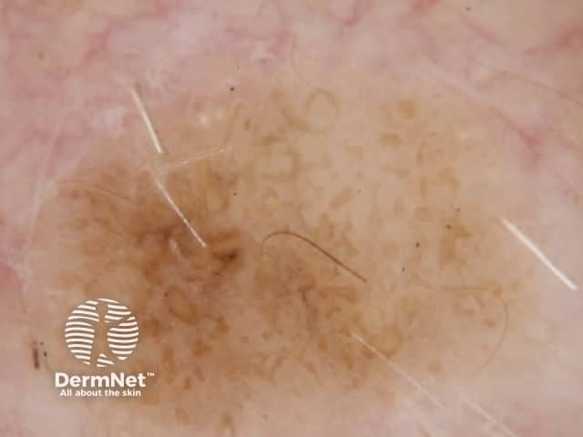Seborrhoeic keratosis dermoscopy