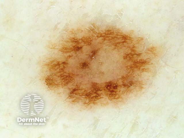 Reticular brown lines