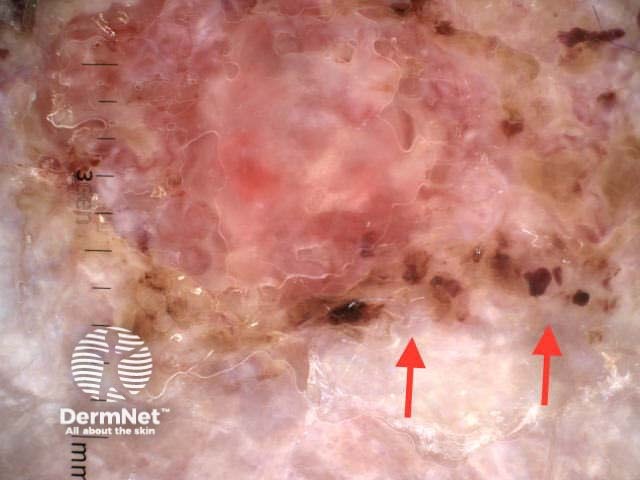 Dermoscopy. Chaos and clues