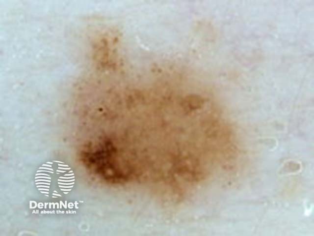 atypical naevus dermoscopy