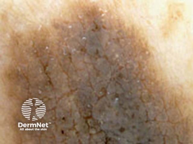 Globular pattern dermoscopy