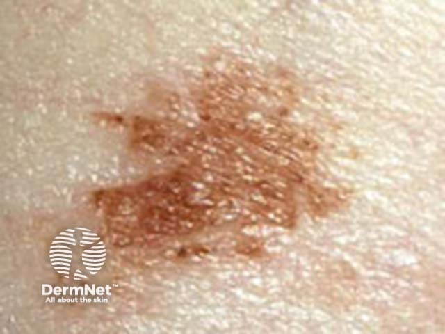 Globular pattern clinical