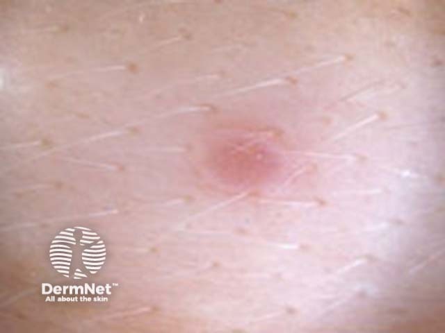 halo naevus dermoscopy