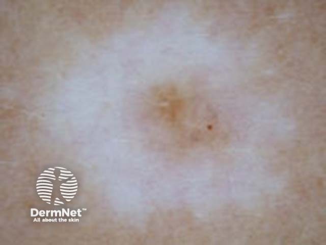 halo naevus dermoscopy