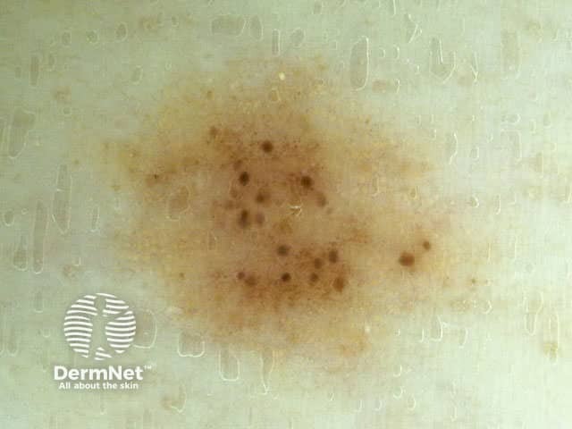 Globular/homogeneous