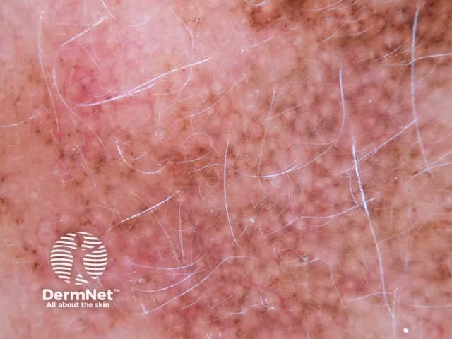 Annular granular pattern seen in dermoscopy of lentigo maligna