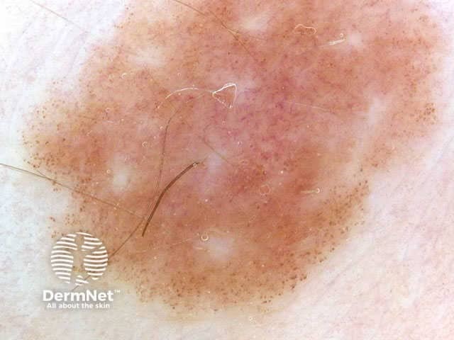 Multifocal pigmentation