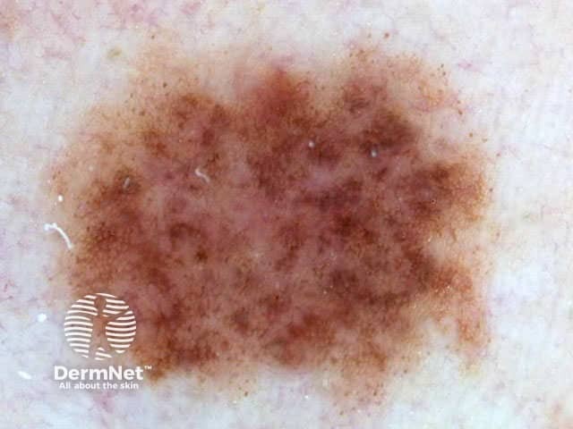 Multifocal pigmentation