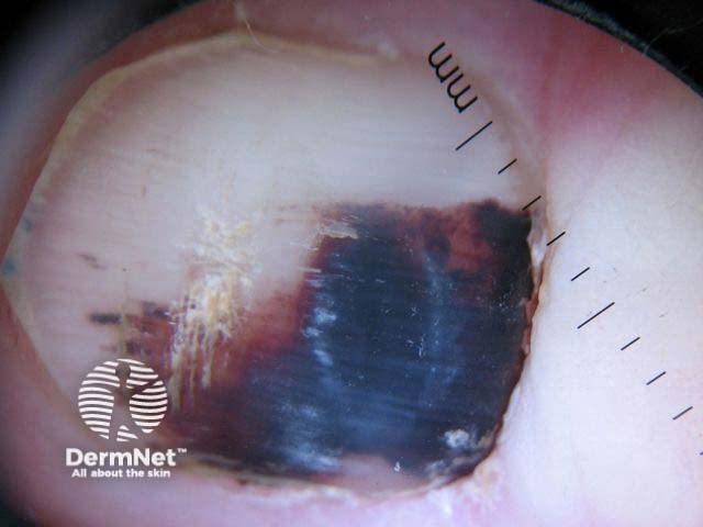 Dermoscopy of subungual haemorrhage