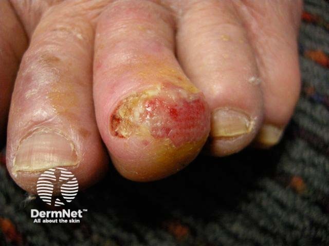 Dermoscopy of subungual melanoma