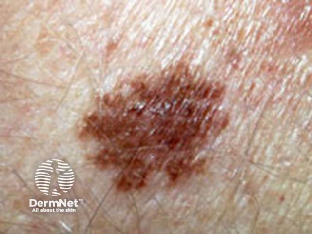 Reticular pattern clinical