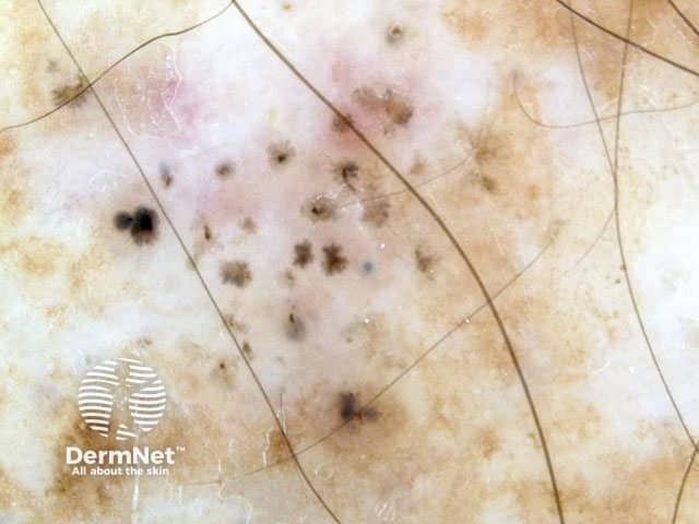 Spoke-wheel pigmentation