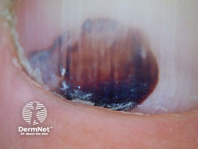Dermoscopy of subungual haemorrhage