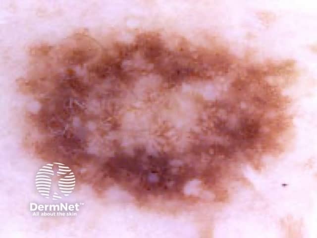 atypical naevus dermoscopy