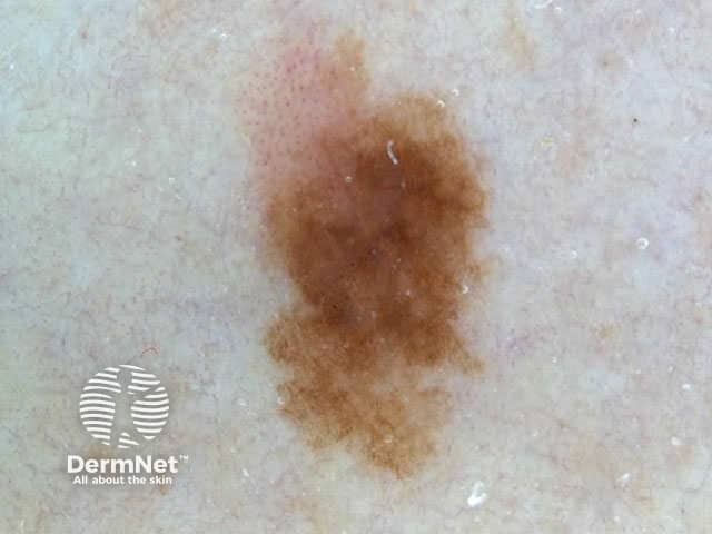 Uniform pigmentation