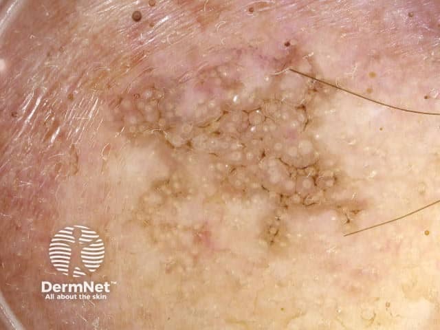 Dermoscopy of actinic keratosis
