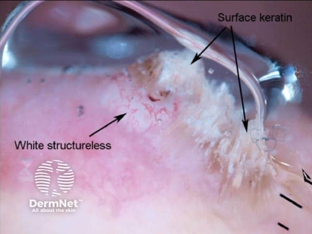 White structures and surface keratin in squamous cell carcinoma dermoscopy