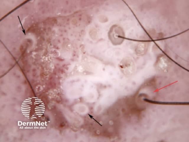 White structureless areas and white circles in squamous cell carcinoma dermoscopy