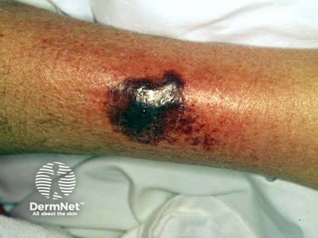 Superficial bullous PG