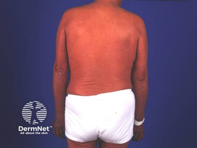 Erythrodermic psoriasis