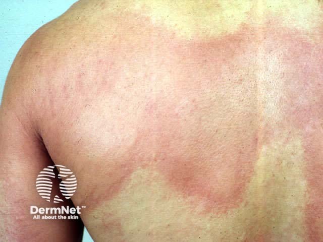 Giant urticaria