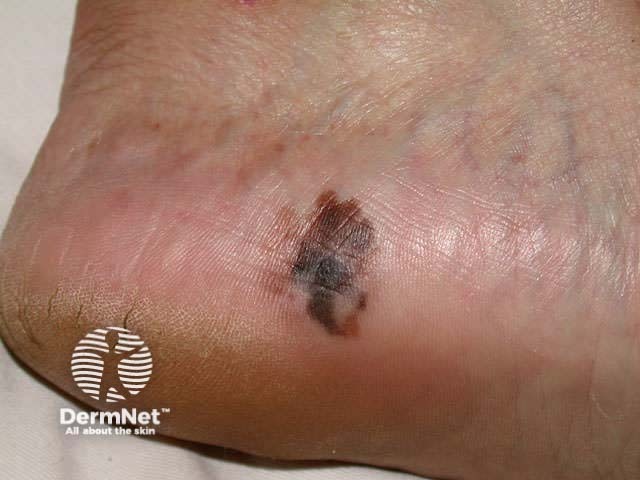 Acral lentiginous melanoma