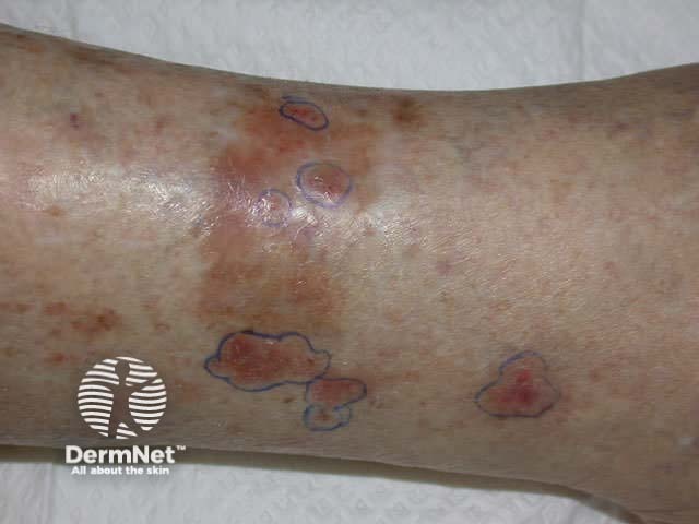 Basal cell carcinoma