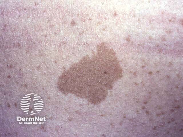 Café au lait macule