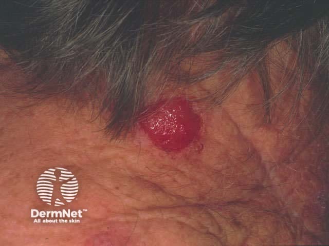 Amelanotic metastasis