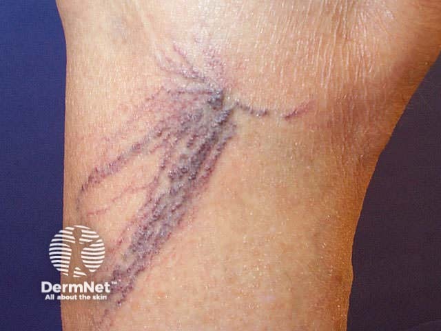 Thread veins / venulectasia (venous disease)