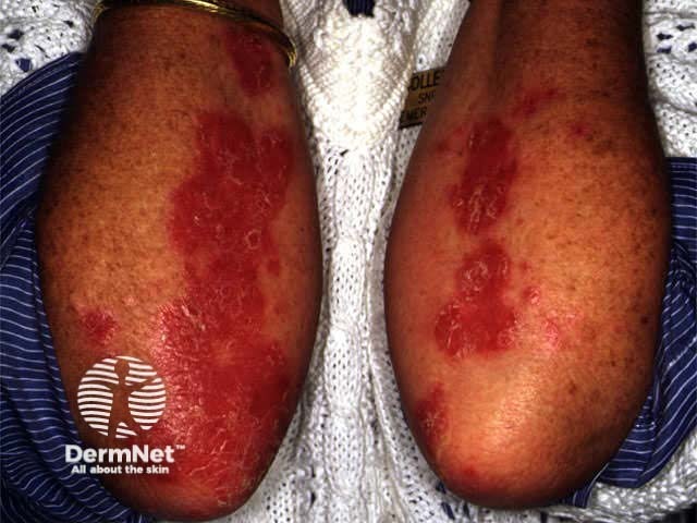 Effect of PUVA on psoriasis