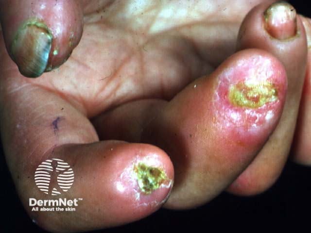 Severe digital resorption