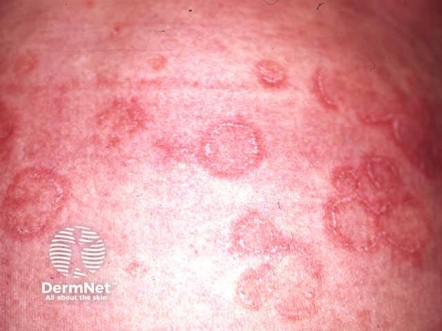 Erythema annulare centrifugum
