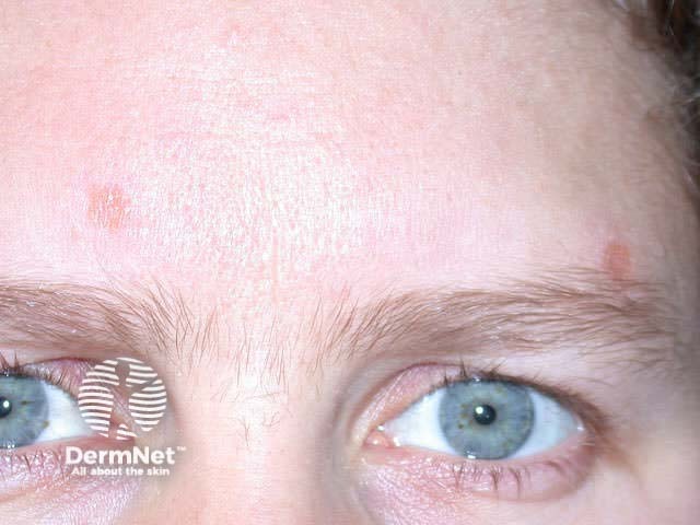 Facial granulomas