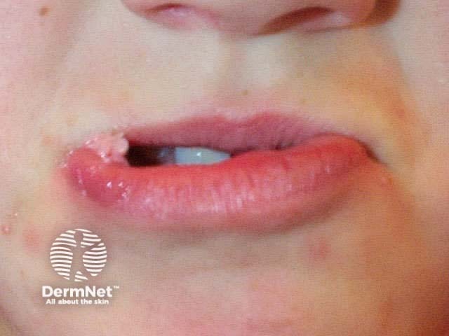 Genital-type warts on lips