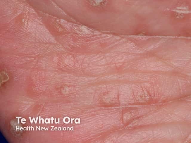 Hand foot and mouth disease