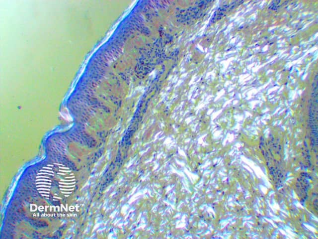 Skin biopsy Congo red-stained specimen viewed under polarised light microscopy