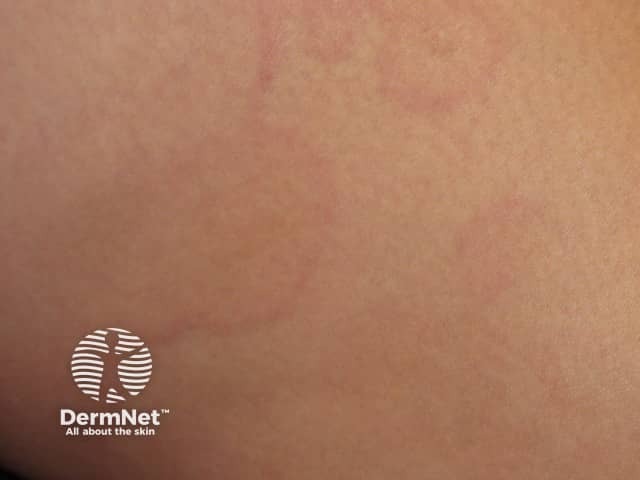 Erythema marginatum