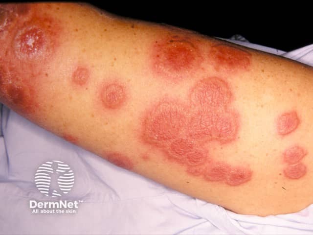 Annular lesions of acute febrile neutrophilic dermatosis