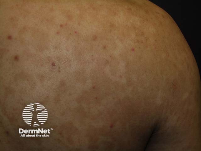 Pityriasis versicolor