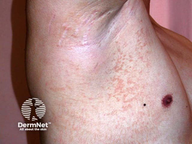 Pityriasis versicolor