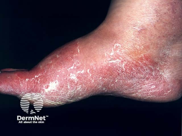 A keratoderma due to dermatophyte infection