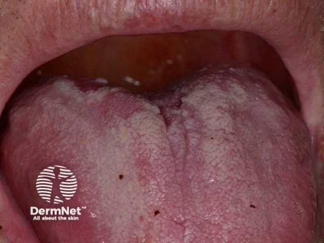 Mouth ulceration and glossitis
