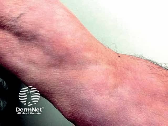 Induration of the skin and the” groove sign” - an indentation along the course of a superficial vein