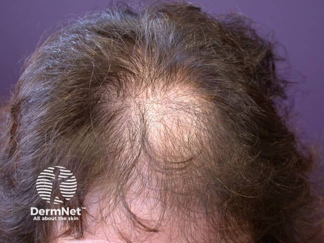 Female pattern alopecia