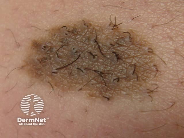 Melanocytic naevus