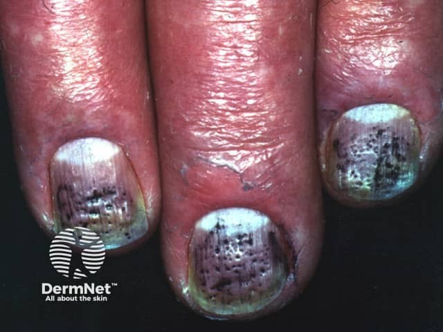 Nails in psoriasis