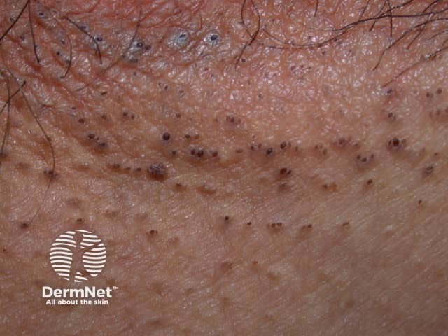 Marked comedones in axillary HS