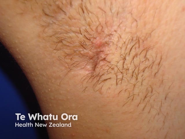 Hidradenitis suppurativa of axilla